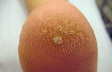 Come riconoscere una verruca di Pierce