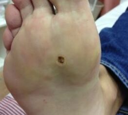 Opportunità per rimuovere le verruche sulla suola delle gambe