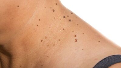 Come sbarazzarsi del papilloma al collo