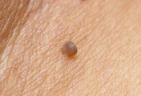 Immagine clinica del papilloma
