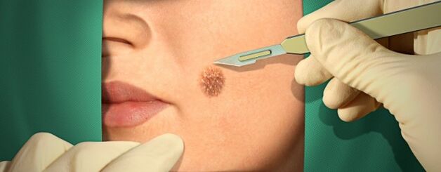 Trattamento chirurgico del papilloma