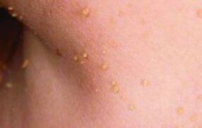 Le ragioni del verificarsi di papillomi sul corpo