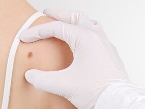 Qual è il pericolo dei papillomi sul corpo