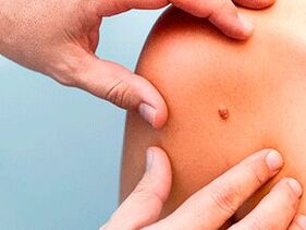 Ragioni per la comparsa di papillomi sul corpo