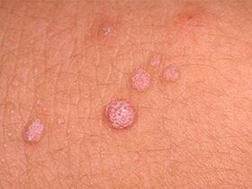 come sbarazzarsi dei papillomi sul corpo