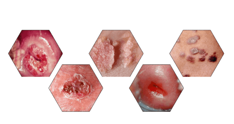 Perché i papillomi sono pericolosi