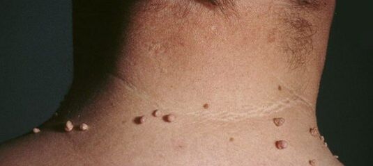 come sbarazzarsi dei papillomi