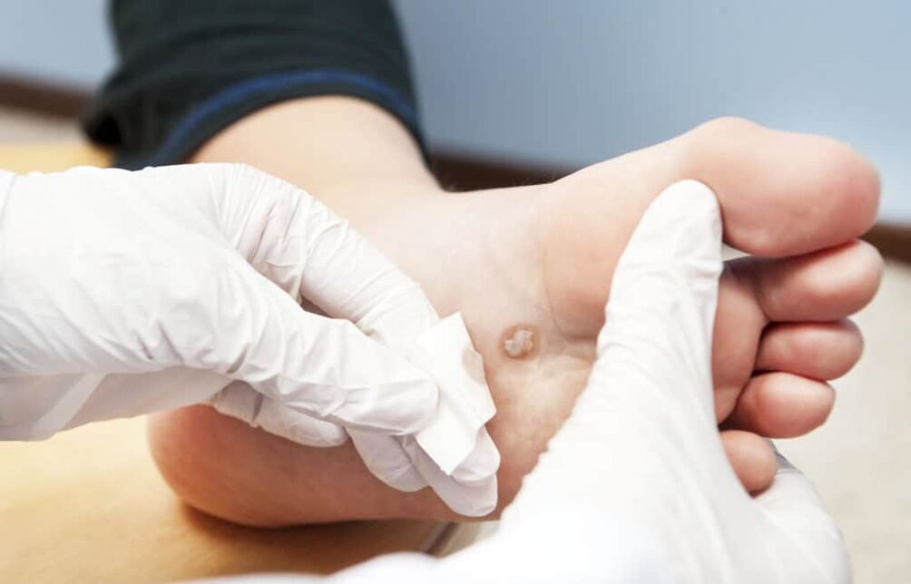 Perché compaiono le verruche sul corpo