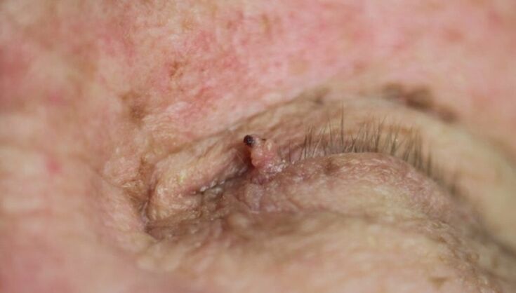 Papilloma sulla palpebra, come liberarsene