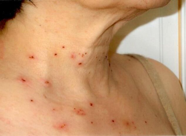 Risultati del trattamento dei papillomi sul collo