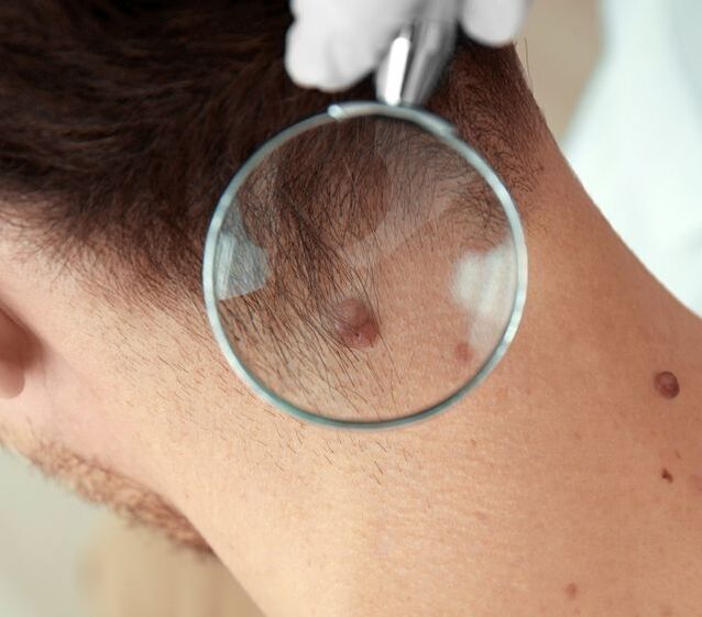 Un medico esamina un papilloma sul collo