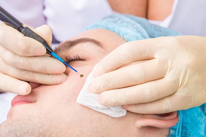 Rimozione di papillomi sul viso dovuti al virus del papilloma umano