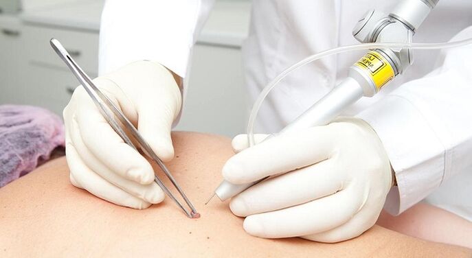 Rimozione laser di papillomi con virus del papilloma